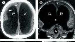 Scientific mystery: Man living with 90% of his brain missing